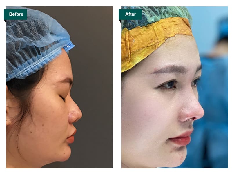 hình ảnh trước và sau khi nâng mũi - Bác sĩ Khải
