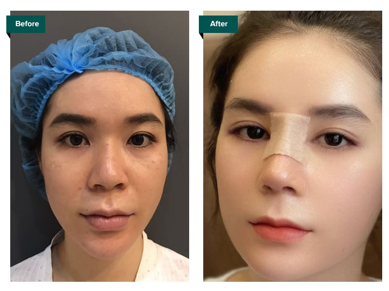 hình ảnh trước và sau khi sửa mũi - Bác sĩ Khải
