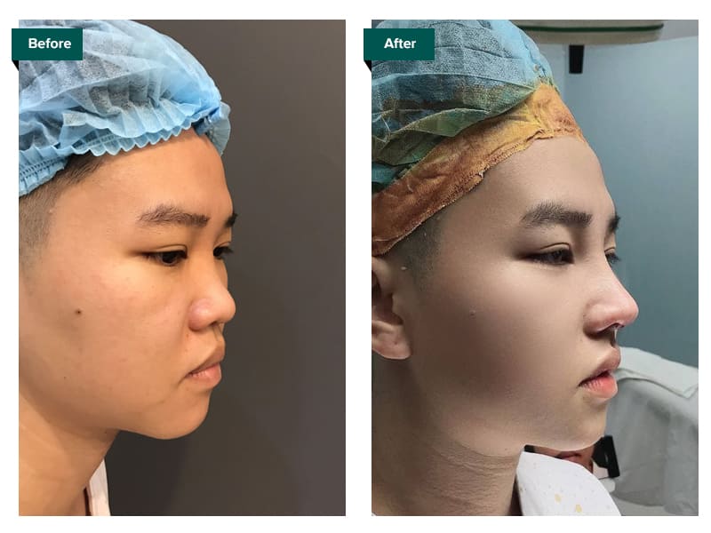 hình ảnh trước và sau sửa mũi như thế nào - Bác sĩ Khải