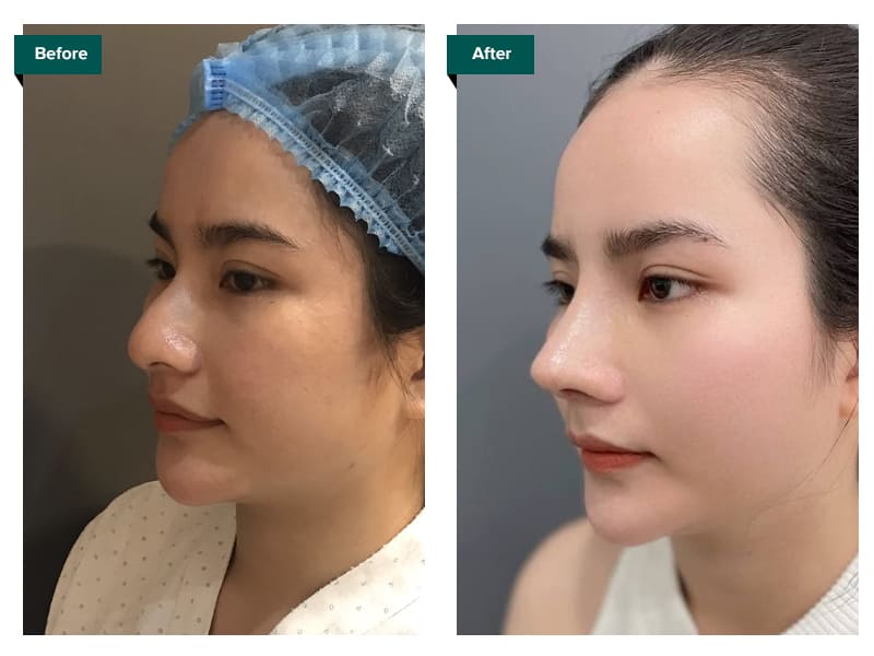 những hình ảnh trước và sau khi nâng mũi - Bác sĩ Khải