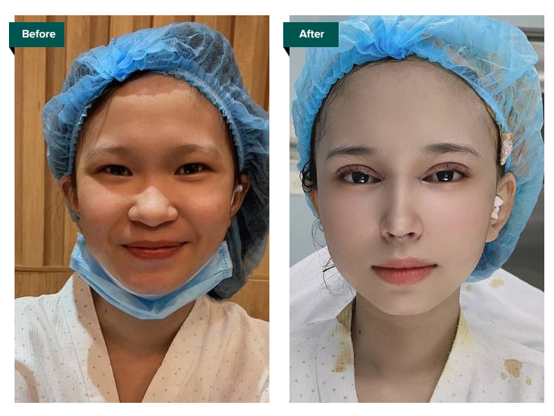 tổng hợp hình ảnh trước và sau khi nâng mũi - Bác sĩ Khải