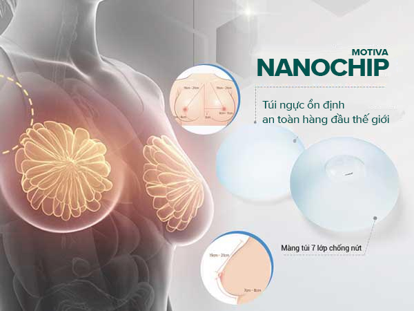 Nâng ngực túi Nanochip - Bác sĩ Khải