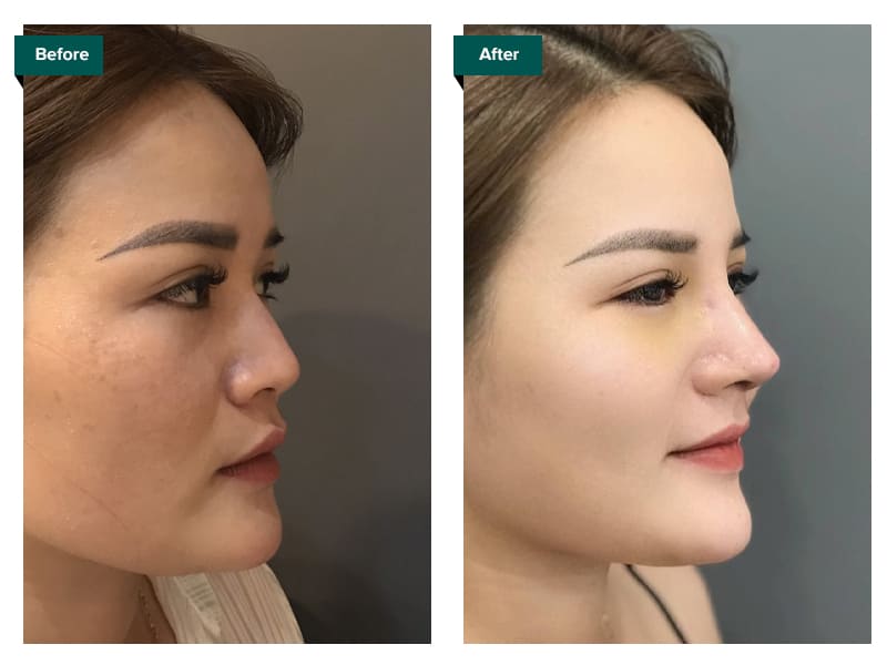 ảnh trước và sau khi nâng mũi - Bác sĩ Khải