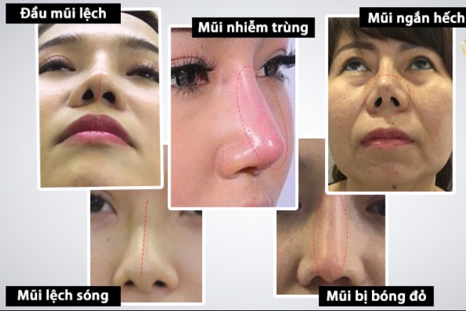 Chỉnh sửa mũi hỏng: Khắc phục biến chứng nguy hiểm sau nâng mũi
