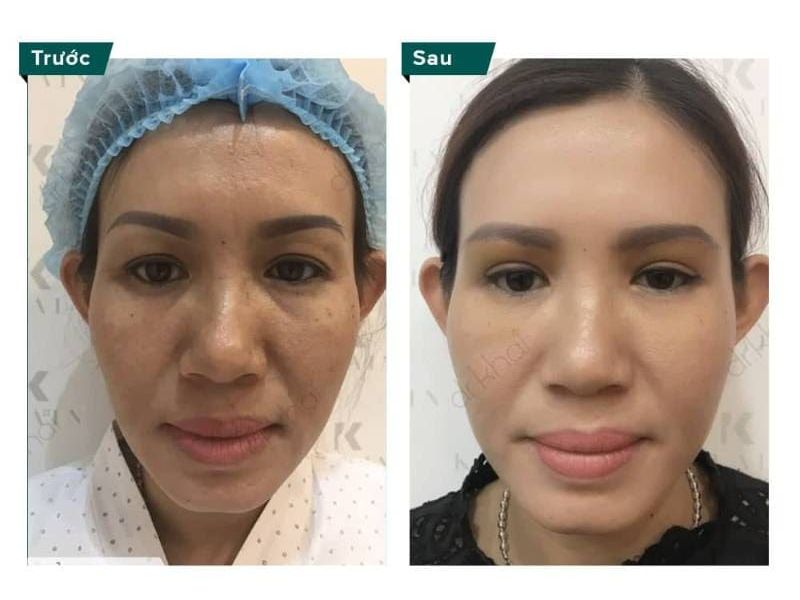 phương pháp giúp trẻ hoá da mặt